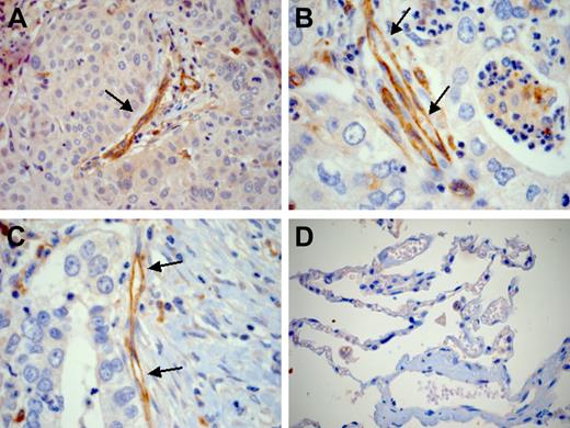 Figure 7. Drm/gremlin immunohistochemistry in human lung cancers. Endothelial cells of tumor vessels (arrows) show a strong Drm/gremlin immunoreactivity in human lung squamous-cell carcinoma (A) and adenocarcinoma (B-C). Squamous tumor cells are weakly immunoreactive (A). No or very weak immunoreactivity is detected in nonneoplastic lung tissue adjacent to the tumor (D). Original magnification, × 200 (A,D); × 400 (B,C).