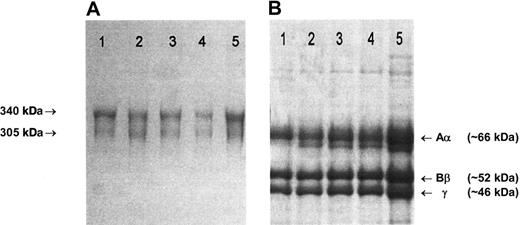 Figure 1. SDS-PAGE of purified fibrinogen. (A) A 4% nonreducing SDS-PAGE. The arrows indicate the migration positions of the major (340 kDa) and minor (305 kDa) circulating forms of fibrinogen, that have, respectively, fully intact chains or one proteolytically cleaved Aα-chain.22 (B) A 7.5% reducing SDS-PAGE. (A-B) Lane 1: unrelated healthy individual; lane 2: case 1, 29 days before transplantation; lane 3: case 1, 46 days after transplantation; lane 4: case 2, immediately before transplantation; lane 5: case 2, 92 days after transplantation. Gels were stained with Brilliant blue R250. Fibrinogen preparations from cases 3 to 5 migrated in an identical manner to those shown here.