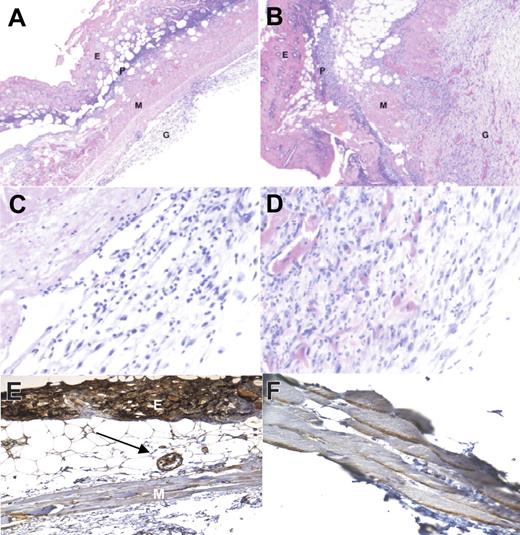 Figure 5. Increased angiogenic and spindle cell responses in random ischemic flaps in the absence of endogenous TSP1. Sections from necrotic areas of the excised skin flap in WT (A) and TSP1-null (B) mice are shown. In WT mice the epidermis (E) is necrotic and heavily infiltrated by polymorphonuclear leukocytes (P). A layer of loose granulation tissue (G) is present under the muscular layer (M). The layer of granulation tissue is significantly thicker and more heavily vascularized in the skin flap of the TSP1-null mouse. H + E; original magnification, × 4. Higher magnification of the granulation tissue in the WT (C) and TSP1-null (D) flaps shows more prominent spindle-cell proliferation and capillary formation in the TSP1-null flap. H + E; original magnification, × 20. Immunohistochemical staining with a TSP1 monoclonal antibody of wild-type flaps at 4 hours (E) and 72 hours (F) after surgery was performed. Tissue obtained 4 hours after surgery demonstrated diffuse TSP1 staining of the epidermis, subcutaneous arterioles (arrow), extracellular matrix, striated muscle, and inflammatory cells. At 72 hours after surgery staining was localized to muscle cell borders and extracellular matrix with less staining in other areas. Original magnification, × 20.