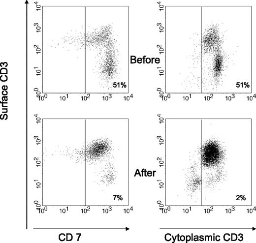 Figure 2. Flow cytometric analysis of duodenal cells obtained from patient B, showing the change in the percentage of aberrant T-cell population before and after ASCT. Aberrant population is shown as CD7+CD3− within CD103+ lymphocytes (left) or as cytoplasmic (cyt) CD3+ surface (surf) CD3− within lymphocyte gate (right). Normal range for cyt CD3+ surf CD3− % of CD103+ lymphocytes is 10% or less.