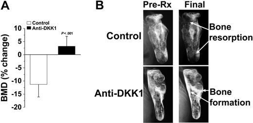 Figure 1. DKK1-neutralizing antibody promotes bone formation in myelomatous bones. SCID-rab mice engrafted with myeloma cells from 11 patients were treated with anti-DKK1 or control IgG antibody. (A) Changes in BMD (mean ± SEM) of the implanted bones from pretreatment levels. (B) X-ray radiographs of the implanted bones at pretreatment and end of experiment. Note that although BMD in control bones was reduced, anti-DKK1 treatment resulted in increased BMD during the experimental period.