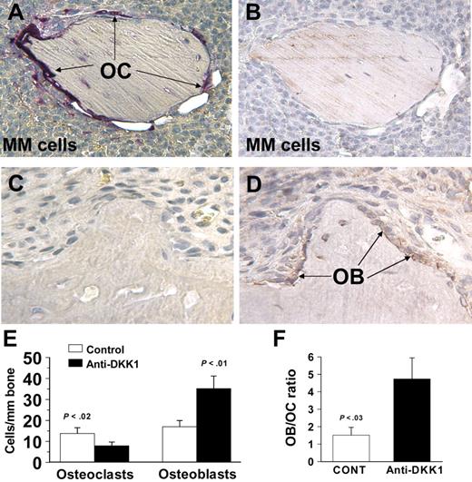 Figure 3. DKK1-neutralizing antibody stimulates osteoblastogenesis and reduces osteoclastogenesis in myelomatous bones. (A-D) Decalcified, sequential, myelomatous bone sections from control (A-B) and anti-DKK1–treated hosts (C,D) were stained for TRAP (A,C) and immunohistochemically stained for osteocalcin (B,D). Whereas in control bones TRAP-expressing osteoclasts covered the whole bone surface and no osteocalcin-expressing osteoblasts were detected, anti-DKK1 treatment resulted in marked reduction in number of osteoclasts and increased number of osteoblasts. OB indicates osteoblasts; OC, osteoclasts. (E-F) Numbers of multinucleated, TRAP-expressing osteoclasts and osteocalcin-expressing osteoblasts (E) and ratio of osteoblasts to osteoclasts in myelomatous bones (F). Data are expressed as mean ± SEM. Original magnification, 200×. Images were obtained using an Olympus BH2 microscope equipped with a 160 ×/0.17 numerical aperture objective (Olympus, Melville, NY). Images were acquired using a SPOT2 digital camera (Diagnostic Instruments, Sterling Heights, MI), and were processed using Adobe Photoshop version 10 (Adobe Systems, San Jose, CA).