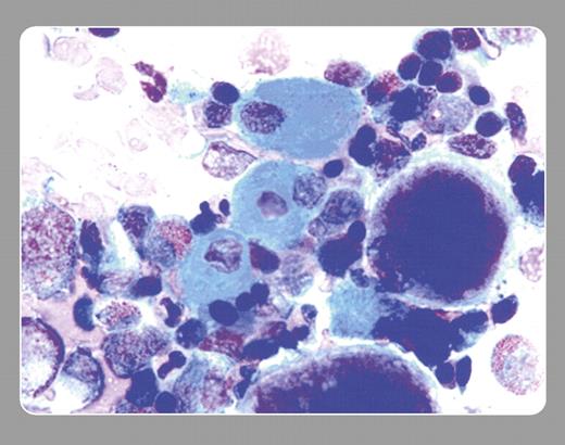 29-year-old woman found unconscious was brought to the emergency room. Her past history included seizures, emotional disorders, and morbid obesity that had been treated with gastric bypass. She was found to have mild pancytopenia and slight elevations of alkaline phosphatase, aspartate aminotransferase, and alanine aminotransferase. Her drugs were amitriptyline, alprazolam, venlafaxine, quetiapine, baclofen, vicoprofen, and valproic acid. . / A bone marrow examination showed mild hypercellularity with myeloid hyperplasia and megaloblastic changes of the red cells. “Sea-blue histiocytes” were very prominently seen as well. . / Sea-blue histiocytes, hepatosplenomegaly, and thrombocytopenia were reported in 1970 (Silverstein et al, N Engl J Med. 282:1-4). Similar histiocytes were reported in the liver, spleen, lymph nodes, and tonsils. Sea-blue histiocytes are also noted as a secondary phenomena of myeloproliferative disease, hyperlipidemia, lysosomal storage disease (Gaucher and Niemann-Pick), lymphoma, myelodysplastic disorders, with total parenteral nutrition, idiopathic thrombocytopenic purpura, and viral disorders. . / The patient's medications were continued except for valproate. Shortly thereafter, her complete blood count normalized. One month later the marrow was repeated, and sea-blue histiocytes had disappeared. An association between sea-blue histiocytes and a drug, such as valproic acid, has not yet been reported.