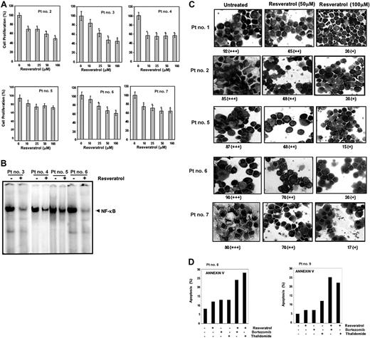 Figure 7. Resveratrol inhibits the proliferation of CD138+ cells from patients with MM and down-regulates NF-κB and STAT3 activation. (A) Enriched CD138+ cells (2 × 105/0.1 mL) from bone marrow aspirates of patients with multiple myeloma were cultured in the absence or presence of indicated concentrations of resveratrol for 24 hours, and cell proliferation was measured by MTT assay as described in “Materials and methods.” Values represent the mean ± SD of triplicate cultures. *P < .05. (B) Enriched CD138+ cells (2 × 106 cells) from bone marrow aspirates of patients with MM as indicated were cultured in the absence or presence of resveratrol (50 μM) for 12 hours and then tested for NF-κB activity in the nuclei by electrophoretic mobility shift assay as described in “Materials and methods.” (C) STAT3 activation status was determined by fixing the untreated and 12-hour resveratrol-treated (50 μM, 100 μM) enriched CD138+ cells (2 × 106 cells) on slides by cytospin followed by immunocytochemistry for STAT3 as described in “Materials and methods.” Patient's numbers are indicated beside each panel. Original magnification, × 200. One hundred cells were counted for each patient. Grading was as follows: + indicates less than 10% cells with nuclear positivity; ++, 10% to 50% cells with nuclear positivity; +++, greater than 51% cells with nuclear positivity. The ++ and + indicate significantly different nuclear (P < .05) positivity than untreated cells. (D) CD138+ cells (2 × 104 cells) from patients no. 8 and no. 9 were treated with 25 μM resveratrol, 20 nM bortezomib, 10 μg/mL thalidomide either alone or in combination for 24 hours at 37°C. Cells were incubated with anti–annexin V antibody conjugated with FITC and then analyzed by a flow cytometer for early apoptotic effects.