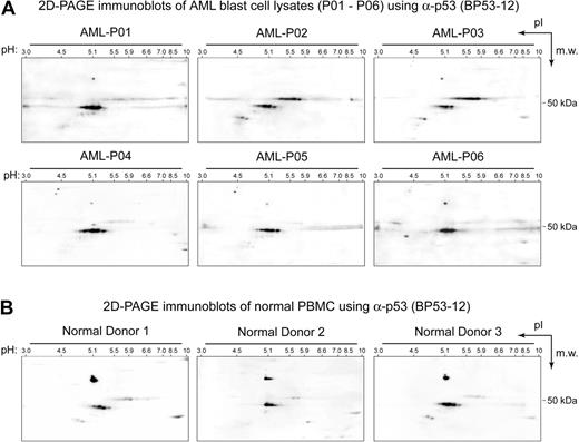 Figure 1. Expressed, wild-type p53 in primary AML blasts exists in several acidic isoforms not seen in resting normal cells. (A) Expression of wild-type p53 was detected at high levels in AML blast samples. However, the acidity and expression level of p53 isoforms was variable among AML patients, such that the 2D pattern of p53 created a signature that distinguished AML patients from one another. (B) In contrast, full-length wild-type p53 was expressed at low levels (53-kDa band) and with a consistent 2D pattern in PBMCs from healthy donors.