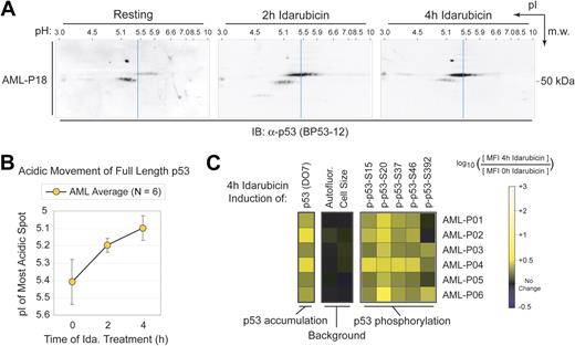 Figure 3. Phosphorylation of wild-type p53 is induced by DNA damage in AML. (A) Idarubicin treatment of AML blasts led to rapid accumulation of numerous full-length p53 isoforms of high acidity. The blue line indicates the resting pI of the most acidic full-length p53 isoform for this representative AML patient sample (AML-P18). (B) The change in pI of full-length p53 following idarubicin treatment was measured in AML blast samples from 6 patients. The acidic movement of full-length p53 relative to that in untreated cells was statistically significant (n = 6). Similar results were obtained for normal PBMCs. (C) Phosphorylation of p53 at 5 residues (serines 15, 20, 37, 46, and 392) and total per-cell level of p53 were detected by phospho-specific flow cytometry in AML blast samples from 6 patients. Phosphorylation and accumulation of p53 in AML blast samples following DNA damage was measured as the log10-fold increase in MFI at 4 hours following idarubicin treatment, as compared to cells treated with idarubicin and fixed immediately (0 hours). Black indicates a comparable MFI was observed at 4 hours and 0 hours.