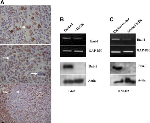 Figure 3. Bmi-1 expression in EBV-negative HL cells is also NF-κB dependent. (A) Immunohistochemistry for Bmi-1 in primary HL. (Top) Typical nuclear staining of HRS cells (arrow) observed in most patients. Only 3 of 60 patients lacked Bmi-1 expression. (Middle) Typical image showing lack of HRS cell expression of Bmi-1 (arrow). (Bottom) Mantle zone (MZ) B cells and centrocytes (CC) were Bmi-1 positive in control tonsil, whereas centroblasts (CBs) were negative. Images were acquired using a Zeiss Photomicroscope II equipped with a Nikon Coolpix990 camera (Nikon, Kingston upon Thames, United Kingdom) and using Corel Paint Shop Pro v.10 software (Maidenhead, United Kingdom). Top two images were acquired with a 60 ×/1.40 NA oil-immersion objective lens (Nikon, Kingston upon Thames, United Kingdom); the bottom image, with a 40 ×/0.65 NA dry objective lens. (B) Treatment of L428 cells with the NF-κB inhibitor TLCK resulted in the down-regulation of Bmi-1 expression. Changes in Bmi-1 mRNA (top) and protein (bottom). Similar results were obtained with EBV-negative KMH2 cells (data not shown). (C) KM-H2 cells transfected with a plasmid expressing an IκBκ mutant that inhibits NF-κB activation. Expression of the IκBκ mutant resulted in the down-regulation of Bmi-1 expression compared with cells transfected with control vector.