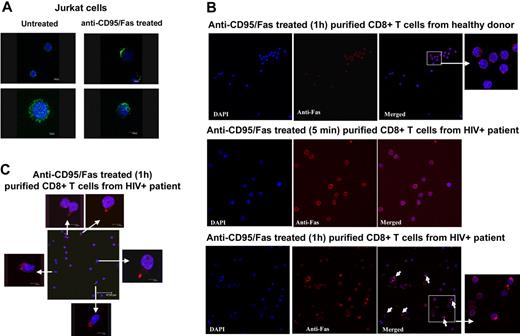 Figure 6. Anti-CD95/Fas treatment induces CD95/Fas capping in purified CD8+ T cells from HIV+ patients but not from healthy donors. (A) Confocal imaging analysis showing CD95/Fas distribution in untreated (left panel) or treated (right panel) Jurkat cells under CD95/Fas-capping conditions. Merged images (blue for DAPI and green for anti-CD95/Fas staining) of representative cells are shown at a single section (top row) or 3D projection (bottom row). (B) CD95/Fas distribution in purified CD8+ T cells from an HIV+ individual and a healthy donor under treatment with anti-CD95/Fas antibody for 5 minutes or 1 hour at 37°C. White arrows point at CD95/Fas-capping cells. Zoomed images of selected fields are also shown. (C) Representative imaging showing the accumulation of CD95/Fas in uropod-like structures extending from the cell surface. Zoomed images of selected fields are also shown. These results are representative of CD8+ T cells from 7 HIV+ patients and 4 healthy donors.