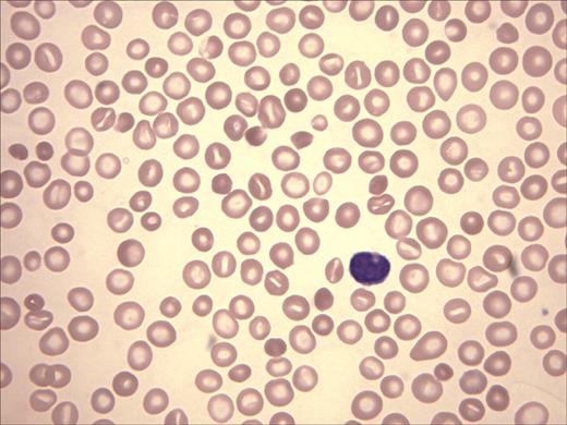 Figure 2. Wright-Giemsa stain of peripheral-blood film. Anisocytosis, hypochromia, target cells, and polychromasia are evident.
