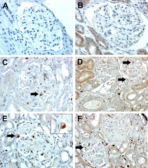 Figure 6. Immunohistochemistry on renal biopsies. Single labeling for CD68 (A,C,E) and for CX3CR1 (B,D,F). Immunohistochemistry was performed on kidney sections from HC (A, B), children with postdiarrheal HUS (C, D), and children with atypical HUS due to factor H deficiency (E, F). The figure shows (arrows) CD68+ and CX3CR1+ cells within glomeruli of children with either form of HUS. Original magnification, × 400 (A-C, E); × 200 (D, F); and × 1000, panel E inset (which shows magnified CD68+ macrophages). Images were acquired using a Leica microscope equipped with a 40 ×/0.65 NA (A-C, E) or 20 ×/0.50 NA (D, F) objective, or a 100 ×/1.30 NA oil-immersion objective lens (E inset). The camera and software (IM 50, V4.0 R11) were also from Leica (Heidelberg, Germany).