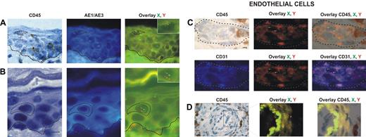 Figure 1. Identification and distribution of chimeric cells in epidermal and dermal compartments of the skin in patients with GvHD. Presence of chimeric keratinocytes, is characterized by CD45 negativity, AE1/AE3 positivity, and X and Y markers (arrows), in the superficial layers of epidermis in a patient in whom a biopsy was taken late in the course of GvHD (day 60) (A), and in the suprabasal layer of epidermis in a patient in whom a biopsy was taken earlier in the course of GvHD (day 35) (B). Presence of chimeric endothelial cells is characterized by CD31 positivity, CD45 negativity, and X and Y markers (arrows) in microvessels of the superficial dermis in all patients with GvHD (C), and in larger vessels of the deep dermis in only one patient with GvHD (D). All scale bars represent 10 μm. Formalin-fixed, paraffin-embedded skin biopsy specimens were cut into 5-μm thick sections. Sister following sections were used for combined immunohistochemistry, FISH, immunofluorescent study and for TUNEL assay. An indirect immunoperoxydase procedure was performed with monoclonal mouse anti–human CD45 antibody (clone PD7/26 and 2B11; Dako, Carpinteria, CA) and secondary biotinylated antibody (Nexes; Ventana, Tucson, AZ). For FISH, the CEP X (SpectrumGreen)/Y (SpectrumOrange) DNA probe (Vysis, Downers Grove, IL) kit was used. Immunofluorescent labeling was carried out with monoclonal mouse anti–human cytokeratin (clone AE1/AE3; Boehringer Mannheim, Indianapolis, IN) and anti–human CD31 (clone JC70A; Dako) as primary antibodies, and AMCA-conjugated horse anti–mouse IgG antibody (Vector Laboratories, Burlingame, CA) as secondary antibody. Bright-field and fluorescent images were obtained by a Provis AX 70 microscope (Olympus, Rungis, France), with wide-field eyepiece number 26.5, providing a field size of 0.34 mm2, through a UPlan FI 40×/0.75 NA objective, and were captured with a ColorView III digital camera (Olympus) using analySIS software version 3.2 (Soft Imaging System).