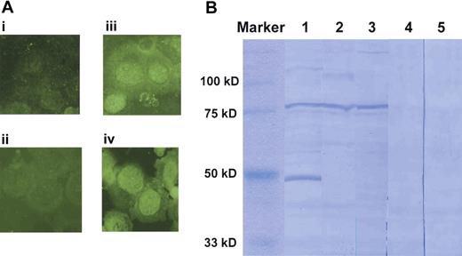 Figure 1. Detection of antibodies (Abs) specific to proteins derived from UT-7 cells in the sera of patients with AA. (A) Immunofluorescence analysis of UT-7 cells using 1:200 diluted sera and FITC-labeled anti–human IgG. (i-ii) Healthy persons; (iii-iv) patients with AA. (B) Western blotting for UT-7 lysates with sera from 3 patients with PNH+ AA (lanes 1-3) and 2 healthy persons (lanes 4-5). Images were obtained using 1000× magnification.