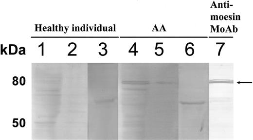 Figure 2. Identification of the 80-kDa protein recognized by IgG Abs of patients with AA. UT-7 lysates (lanes 1, 4), culture supernatants of UT-7 cells (lanes 2, 5, 7), and recombinant Grp 78 protein (lanes 3, 6) were subjected to Western blotting using sera from a healthy person (lanes 1-3), a patients with PNH+ AA (lanes 4-6), and antimoesin monoclonal Ab (lane 7). The arrow indicates 80-kDa protein bands.