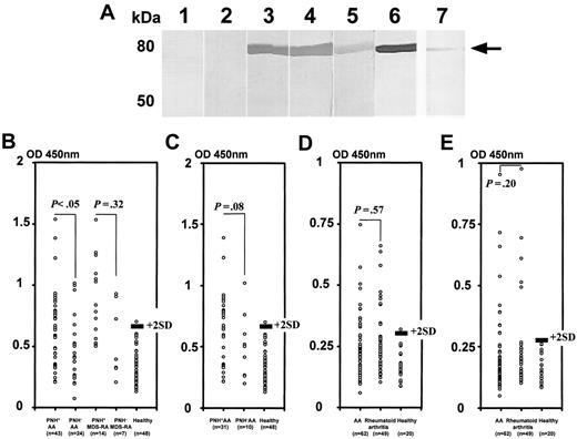 Figure 3. Detection of antimoesin Abs in the sera of patients with AA, MDS-RA, and rheumatoid arthritis. (A) Detection of specific Abs to recombinant moesin in the sera of patients with AA. Purified recombinant native moesin protein was used to detect Abs specific to moesin in sera from 2 healthy persons (lanes 1-2) and 3 patients with PNH+ AA (lanes 3-5). Antimoesin monoclonal Ab was used as a positive control (lane 6). The serum of a patient with PNH+ AA diluted to 1:6400 was also used (lane 7). The arrow indicates recombinant moesin bands. (B-C) Titration of moesin Abs in sera of patients with AA and MDS-RA using ELISA. Antimoesin Ab titers were determined for the sera of 43 patients with PNH+ AA, 24 patients with PNH− AA, 14 patients with PNH+ MDS-RA, 7 patients with PNH− MDS-RA, and 48 healthy persons. (B) All patients. (C) Patients with recently diagnosed AA examined before therapy. (D-E) Titration of Abs specific to C-terminal moesin fragment in the sera of patients with AA and rheumatoid arthritis. Titers of anti–C-terminal moesin fragment Abs were determined in the sera of 62 patients with AA, 49 patients with rheumatoid arthritis, and 20 healthy persons. (D) Antimoesin C-terminal fragment (399-500) M1 Abs. (E) Antimoesin C-terminal fragment (494-577) M2 Abs. The solid line denotes a cutoff value defined as the mean + 2 SDs of the absorbance in healthy persons. P values indicate the differences in the prevalence of patients showing higher antimoesin or moesin-fragment Ab titers between 2 different groups.