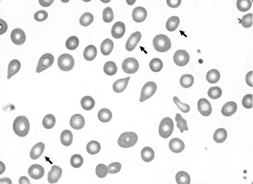 Figure 1. Arrows indicate stubby elliptocytes in Maslak's Blood Works image.