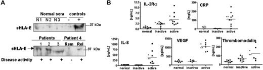 Figure 6. Detection of soluble HLA-E in sera from patients with AASV and correlation with soluble markers of inflammation. (A) Representative immunoblots showing the detection of sHLA-E in sera from patients with AASV (“Materials and methods”). The top panel shows the absence of sHLA-E in the serum from 3 healthy volunteers compared with negative and positive controls. The bottom panel illustrates the presence of sHLA-E in 3 sera from patients (nos. 1-3) with active phase and in 2 sera from 1 patient (no. 4). Rem indicates remission; Rel, relapse). Results are representative of 5 independent experiments. (B) Quantitative analysis of soluble IL-2Rα, CRP, IL-8, VEGF, and thrombomodulin by ELISA assays. *P < .01 versus normal; **P < .01 versus inactive. ND indicates not determined. Horizontal bars correspond to the means of value for each group of sera.
