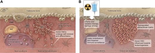 Figure 1. Hematopoietic stem cells (HSCs) and hematopoietic progenitor cells reside in the bone marrow in tissue composed of trabecular bone adjacent to endothelial lined sinuses and surrounded by various stromal cells that include osteoblasts (OB), osteoclasts (OC), chrondrocytes (CC), adipocytes (Ad), and fibroblasts (FB). This tissue also contains a complex environment of extracellular matrix proteins (EMP) and soluble cytokines. The interaction and homeostasis of these stromal components with the HSCs may determine its normal or neoplastic fate after hematopoietic cell transplantation (HCT). Figure 1A illustrates the normal HSC niche in which donor HSCs undergo self-renewal and differentiation to donor progenitor cells (PCs). Figure 1B illustrates the altered environment after HCT in which changes in the balance of extrinsic signals because of chemotherapy and radiation therapy may influence normal donor HSC development toward donor cell leukemia (DCL). These changes after HCT include injured stroma, leaky endothelium, impaired tumor surveillance, and a dysregulated extracellular matrix. Illustration by Kenneth Probst.