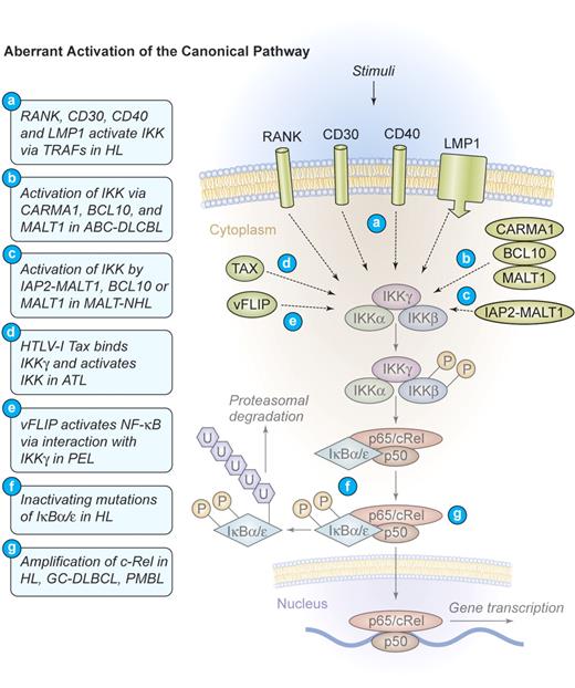 Figure 3. Mechanism of aberrant NF-κB activation through the canonical signaling pathway in human lymphomas. Aberrant activation of the canonical pathway. NF-κB can be aberrantly activated in HL by signals from CD30, CD40, and RANK, which induce the activation of the IKK complex via TRAF proteins. The latent membrane protein 1 (LMP1) of EBV engages the intracellular CD40 signaling machinery in HL. CARMA1, BCL10, and MALT1 are key upstream mediators of NF-κB activation in ABC-DLBCL. The viral oncoproteins TAX of HTLV-I and vFLIP of HHV-8 are able to bind IKKγ and induce constitutive IKK activation in ATL and PEL, respectively. The fusion protein IAP2-MALT1 or deregulated expression of the proteins MALT1 or BCL10 frequently activates the IKK complex in MALT lymphomas. Deregulated MALT1 expression is also found in selected cases of marginal zone lymphoma (MZL) and Burkitt lymphoma. Inactivating mutations of IκBα/ϵ, resulting in a decreased inhibitory function and a persistent NF-κB transcriptional activity, have been identified in HL. Amplifications of c-Rel have been recognized in HL, germinal center (GC)–DLBCL, and primary mediastinal B-cell lymphoma (PMBL). Illustration by Kenneth Probst.