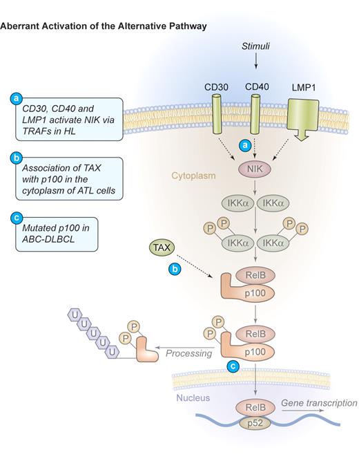 Figure 4. Mechanism of aberrant NF-κB activation through the alternative signaling pathway in human lymphomas. Aberrant activation of the alternative pathway. Signaling through CD30, CD40, and LMP1 also activates the alternative NF-κB pathway via NIK and IKKα in HL. These events lead to the phosphorylation and proteolytic processing of the NF-κB2 precursor protein p100 as well as the translocation of mature p52/RelB dimers into the nucleus. In ATL, TAX can bind to p100 in the cytoplasm and increase its proteolytic processing. Mutations of NF-κB2/p100, leading to a decreased inhibitory p100 function and an increased p52 activity, have been found in cases of ABC-DLBCL. Illustration by Kenneth Probst.