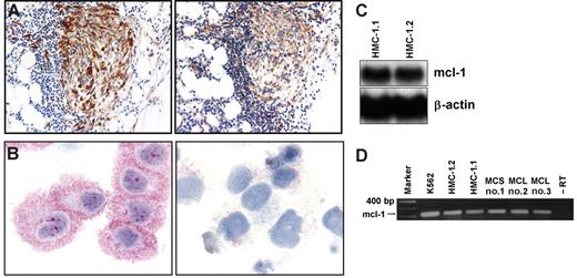 Figure 1. Expression of MCL-1 in neoplastic human mast cells. (A) Immunohistochemical detection of tryptase (left) and MCL-1 (right) in neoplastic MCs in a patient with indolent SM (ISM). Adjacent bone marrow sections were incubated with antibodies against tryptase or MCL-1. Immunohistochemistry was performed as described. (B) Immunocytochemical detection of MCL-1 in HMC-1.2 cells exhibiting the KIT mutation D816V (left). Immunocytochemistry was performed using a polyclonal anti–MCL-1 antibody. Preincubation of the antibody with a specific blocking peptide resulted in a negative stain (right). Similar staining results were obtained with HMC-1.1 cells lacking KIT D816V (not shown). (C) Northern blot analysis of HMC-1.1 cells and HMC-1.2 cells using an MCL-1–specific cDNA probe. β-Actin loading control is also shown. (D) RT-PCR analysis of MCL-1 mRNA expression in K562 cells, HMC-1.1 cells, HMC-1.2 cells, and purified (purity greater than 98%) neoplastic human mast cells obtained from one patient with mast cell sarcoma (MCS) (patient 1) and 2 patients (patients 2 and 3) with mast cell leukemia (MCL). The PCR reaction was controlled by omitting the RT step (−RT).