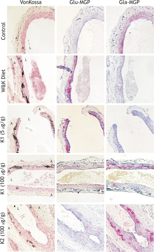 Figure 2. Effect of different dietary treatments on aortic calcification at the 12-week time point in male Wistar Kyoto rats. Rats (n = 6 per group) were treated with the following dietary regimens; row 1 represents 12 weeks of normal vitamin K diet (5 μg/g K1), row 2 represents 12 weeks of the W&K diet (3 mg/g warfarin and 1.5 mg/g vitamin K1), row 3 represents 6 weeks of normal vitamin K (5 μg/g K1) after 6 weeks of W&K, row 4 represents 6 weeks of high–vitamin K1 (100 μg/g) diet after 6 weeks of W&K, and row 5 represents 6 weeks of the high–vitamin K2 (100 μg/g) diet after 6 weeks of W&K. The thoracic aorta segment (between the aortic arch and the renal branch) was removed immediately after killing the animals in each diet group and fixed in 1% buffered formalin. Subsequently, longitudinal sections of each aorta were stained for mineral by von Kossa stain (column 1), ucMGP (column 2), and cMGP (column 3). Red stain indicates MGP, black stain indicates calcium, and blue indicates cell nuclei. Magnification, × 100. Acquisition was performed using an Axioskop 40 microscope (Carl Zeiss, Sliedrecht, The Netherlands) equipped with Achroplan 10×/0.25 objective lens and using an E-PI 10×/20 aperture. Pictures were taken using a Canon Powershot G5 (Canon, Hoofddorp, The Netherlands) and corrected for contrast and brightness using Adobe Photoshop CS2 for Windows (Adobe Systems, San Jose, CA).
