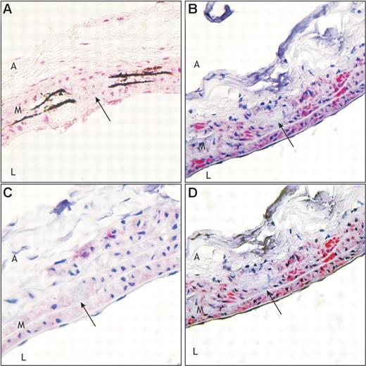 Figure 4. Effect of the high-K2 treatment (100 μg/g vitamin K2) on the presence of calcification and MGP at the 12-week time point. Sections were prepared as described in the legend of Figure 2. Longitudinal sections of each thoracic aorta were stained with von Kossa (A) and immunohistochemically with anti–t-MGP (B), anti-ucMGP (C), and anti-cMGP (D) (see “Materials and methods” for details). It is shown that because of the high-K2 diet cMGP (D) is up-regulated in the calcified area (A; along the elastic fibers). From panel C it can be seen that ucMGP is almost absent. Arrow indicates same area. Red stain indicates MGP, black stain indicates calcium, and blue indicates cell nuclei. Magnification, × 400. A indicates adventitia; M, media; and L, lumen. Details of image acquisition are provided in the legend of Figure 2.