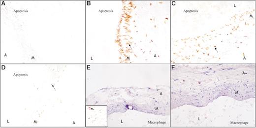 Figure 6. Effect of different dietary treatments on apoptotic activity at the 12-week time point. Sections were prepared as described in the legend of Figure 2. Longitudinal sections of each thoracic aorta were stained by immunohistochemical techniques with an antimacrophage antibody and with a terminal dUTP nick-end labeling (TUNEL) staining for apoptosis (see “Materials and methods” for details). Panel A represents 12 weeks of normal vitamin K diet (5 μg/g K1), panels B and E represent 12 weeks of W&K diet (3 mg/g warfarin and 1.5 mg/g vitamin K1), panel C represents normal K (5 μg/g) after 6 weeks of W&K, and panels D and F represent 6 weeks of high vitamin K (100 μg/g K1 or K2) after 6 weeks of W&K. Macrophages are absent in the medial layer of aortic tissue, both in rats treated with W&K (E) and high vitamin K (F). Also, in control animals macrophages were absent (data not shown). In panel E a positive control is shown as an inset (arrow indicates macrophage). The W&K-treated animals (B), however, have significantly increased apoptosis of vascular smooth muscle cells (VSMCs) compared with control animals (A), in which apoptosis is hardly measurable. Also in the normal K-treated animals, after 6 weeks of W&K, (C) apoptosis is clearly visible. The rats treated with high vitamin K (D) showed significantly reduced apoptosis as compared with the normal-treated animals (C). See “Results” for details. Magnification, × 400. Details of image acquisition are provided in the legend of Figure 2.