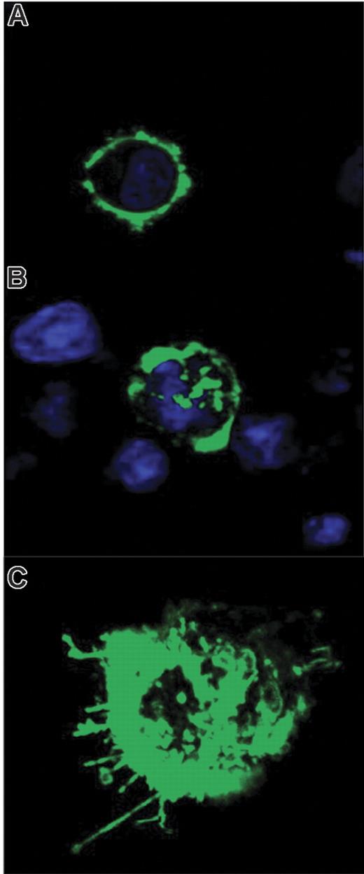 Figure 2. YFP-CXCR4 localization in response to SDF-1. (A) YFP-CXCR4 expression on the surfaces of MM.1S cells in unstimulated cells as determined by the fixed cell method. (B) Internalization of the CXCR4 receptor in response to SDF-1 (30 nM) stimulation for 1 hour. (C) Live cell method with 3D reconstruction demonstrating CXCR4 cytoskeletal rearrangement, capping, and pseudopodia formation in response to SDF-1.