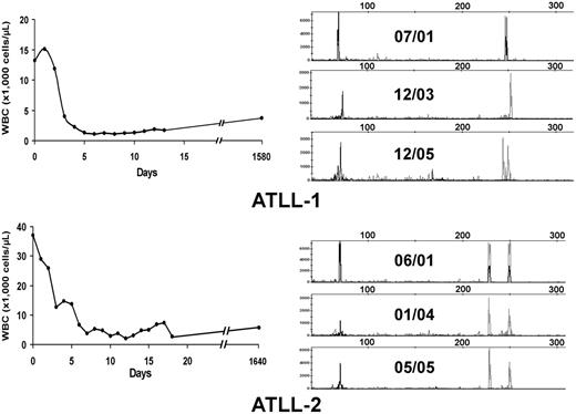 Figure 1. Hematologic and molecular response to AZT and IFN-α in ATLL patients. (A, left) WBC counts were plotted over time for 2 ATLL patients with leukemia after induction and during antiviral treatment. (B, right) Analysis of T-cell clones is demonstrated by combined multiplex PCR at the specified dates for these 2 patients using two sets of reaction primers, including those specific to the V1-8, V9, and consensus J1 and J2 regions of βchain TCR genes (peaks to the right) or alternative J1 and J2 regions (peaks to the left).
