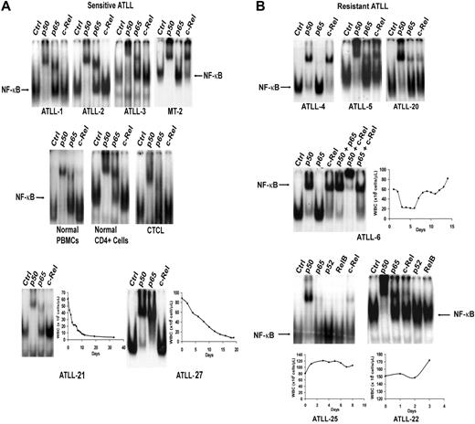 Figure 2. Analysis of expression of NF-κB/Rel subunits in primary ATLL cells by EMSA. Nuclear extracts from leukemic cells of (A) antiviral-sensitive (ATLL-1, ATLL-2, ATLL-3, ATLL-21, ATLL-27) and (B) antiviral-resistant (ATLL-4, ATLL-5, ATLL-6, ATLL-20, ATLL-22, ATLL-25) tumors were incubated with the indicated antibodies specific for the different NF-κB subunits and 32P-labeled oligonucleotide containing a consensus NF-κB–binding sequence and were separated by gel electrophoresis. PBMCs from a healthy subject, isolated CD4+ cells from normal PBMCs, a leukemia patient with CD4+CD25+ mycosis fungoides/CTCL (HTLV-1 negative) (WBCs, 70 × 109/L), and MT-2 cells (c-Rel+, HTLV-1+ line) were used as controls. The NF-κB complex was further characterized by supershifting with several antibody combinations in one patient (ATLL-6). WBC counts over time during induction AZT and IFN-α therapy curves are demonstrated in the selected leukemia patients.