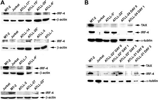 Figure 3. IRF-4 and Tax protein expression in primary ATLL tumors before and after cell culture. (A) Western blot analysis demonstrating Tax and IRF-4 protein status in primary unmanipulated and cultured ATLL tumors. (B) In selected patients, IRF-4 and Tax protein expression was measured ex vivo before cell culture (day 0) and on in vitro culture for the indicated time periods (day 1, 24 hours; day 2, 48 hours; day 3, 72 hours). Whole cell lysates from MT-2 and Jurkat lines were used as positive and negative controls, respectively. *Tumors from patients in whom AZT and IFN-α therapy failed.