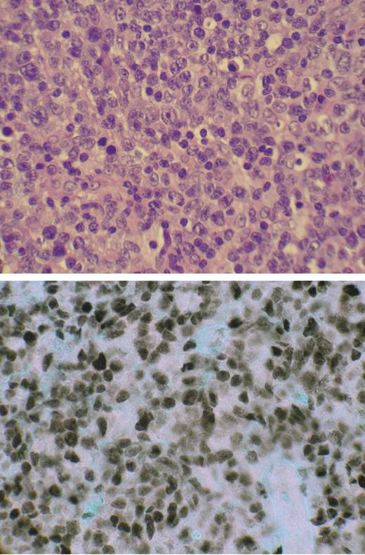 Figure 4. Expression of nuclear IRF-4/MUM-1 in ATLL lymphoma specimen. (top) Hematoxylin and eosin–stained paraffin-embedded section of tumor-infiltrated lymph node from patient ATLL-20. (bottom) IRF-4/MUM-1 antibody (Dako) staining by immunohistochemistry of mirror section.