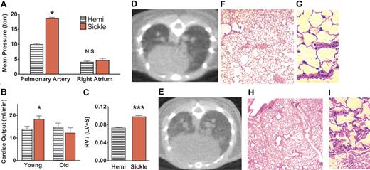 Figure 1. Pulmonary artery pressures were elevated in sickle mice and associated with decreasing cardiac output and right-heart failure with advancing age. (A) Elevated pulmonary artery pressures in younger sickle mice (3 to 5 months old, n = 7) were associated with normal right atrial pressures. (B) Elevated cardiac output in younger sickle mice contrasted with low cardiac output in older sickle mice (13 to 15 months old, n = 4). (C) The Fulton ratio of ventricular weights (right ventricle–left ventricle including septum) indicated disproportionately heavier right ventricles in sickle mice than in hemizygous controls (n = 11 and 16, respectively). Hearts were excised and sectioned using the method of Fulton55,56 from younger mice not used for other cardiac studies. (D) Thoracic micro-CT of the hemizygous control in vivo demonstrated normal heart size, lung vasculature, and lung aeration. (E) CT in vivo of the sickle mouse at the same axial level showed an enlarged heart. Lungs were very similar to normal, except for dilated pulmonary vessels and mildly increased attenuation with a speckled pattern consistent with perfusion heterogeneity (n = 11). (F) Hemizygous control mouse lung histology at low magnification had normal lung parenchyma and vascularity and (G) at high magnification demonstrated normal thin alveolar capillaries. (H) Sickle mouse lung histology at low magnification confirmed the radiologic findings of dilated pulmonary vessels and patchy vascular congestion. However, pulmonary arterial walls were not significantly thickened, and no plexiform lesions were observed. (I) Histology at high magnification showed engorged alveolar capillaries. No sickle mouse of any age had intra-alveolar edema, fat and/or bone marrow emboli, thromboemboli, pulmonary infarcts, or significant interstitial fibrosis. *P < .05 versus age-matched hemizygous control. ***P < .001 versus age-matched hemizygous control. CT scans (panels D-E) acquired by MicroCAT II (Imtek, Knoxville, TN) were processed by image analysis software (Amira 3.0, TGS Inc, San Diego, CA) and formatted using Adobe Photoshop (Adobe Systems, San Jose, CA). Photomicrographs of lung sections stained with hematoxylin and eosin (panels F-I) were visualized using an Olympus IX70 microscope equipped with UPlanFl 10×/0.30 numerical aperture (NA) and LCPlanFl 40×/0.60 NA PH2 objective lenses (Olympus, Melville, NY); images were acquired by Spot Flex digital camera (Spot Diagnostic Instruments, Sterling Heights, MI) with Spot 3.02 application software, and were formatted using Adobe Photoshop (Adobe Systems, San Jose, CA) and ImageJ software (National Institutes of Health, Bethesda, MD).