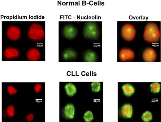 Figure 2. Confocal microscopy images of nucleolin localization in normal B cells and CLL cells. The localization of nucleolin was determined by indirect immunofluorescence using a primary antibody against nucleolin and FITC-conjugated antimouse secondary antibody. DNA was stained with propidium iodide.