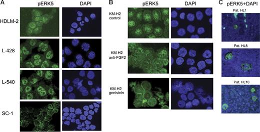 Figure 4. Immunostaining of phospho-ERK5 in HL cell lines and lymph nodes. (A) Cytospins of HL cell lines (HDLM-2, L-428, L-540) and of NHL cell line (SC-1) were stained by immunofluorescence with phospho-ERK5 antibody (magnification, × 630). In contrast to SC-1, HL cells show intensive nuclear staining. DAPI counterstaining indicates the nuclei. (B) The HL cell line KM-H2 was treated with 10 μg/mL anti-FGF2 antibody or with 200 μM tyrosine kinase inhibitor genistein and subsequently stained with anti–phospho-ERK5 (magnification, × 630). In contrast to control cells, treated cells show weak staining of nuclei indicating that (1) FGF2 signaling is mediated by ERK5 and (2) genistein inhibits this pathway. (C) Lymph nodes obtained from 3 patients with HL (HL1, HL8, HL10) stained with anti–phospho-ERK5 (magnification, × 630) show positive giant cells, indicating a constitutively active ERK5 pathway in H/RS cells.