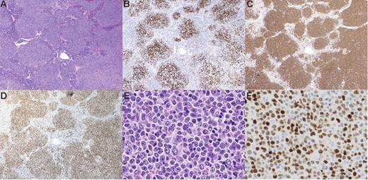 Figure 1. Pathological features of CD10−MUM1+ follicular lymphoma. In H&E sections, the lymphoma cells form definite follicular structures (A). The follicular structures are confirmed by follicular dendritic cell (FDC) meshwork stained for CD21 (B). In this case, almost all lymphoma cells are large cells and their proliferation shows a “sheet-like” pattern (E). This patient was diagnosed as grade 3B. Lymphoma cells are positive for CD20 (C) and MUM1 (D,F). All figures are from patient 7. Original magnification: (A-D) × 10, (E-F) × 100. Images were visualized using an Olympus AX80 microscope (Olympus, Tokyo, Japan), equipped with (A-D) an Olympus Planapo 4×/0.16 numerical aperture (NA) objective or (E-F) an Olympus Planapo 40×/0.95 NA objective. Images were captured using an Olympus DP70 camera and Olympus DP controller software, and were processed using Olympus DP manager software.