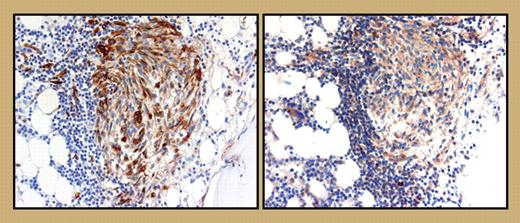 Expression of Mcl-1 in neoplastic human mast cells. See the complete figure in the article beginning on page 3031.