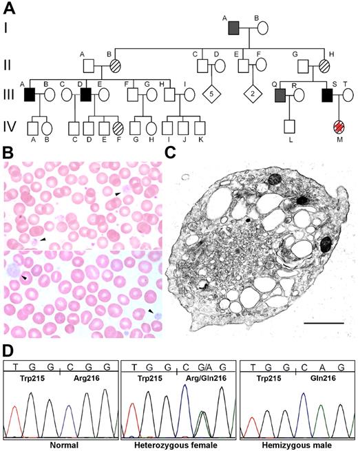 Figure 1. Familial GPS. (A) This pedigree reflects the X-linked pattern of inheritance that was suspected clinically and later confirmed by DNA analysis. Subject I-A was diagnosed with idiopathic thrombocytopenic purpura (ITP) in childhood and died of complications of chronic myelogenous leukemia. His medical record contains frequent references to his abnormally large platelets. Subject III-A has been extensively evaluated for his history of chronically low platelets without a definitive diagnosis. Subject III-D had a splenectomy to manage persistent thrombocytopenia. ▪, affected; ▨, carrier; ▪, inferred from clinical history; ⋄, not tested; □, not affected; ☆, proband. (B) The proband's blood smear (IV-M) contains normal-appearing platelets and a population of abnormally large, pale, agranular platelets (arrowheads). A blood smear from the proband's father (III-S) contains decreased platelets, and those present have similarly abnormal morphology. (C) Electron micrograph (EM) of a peripheral blood platelet from subject III-S shows a large platelet with enlarged elements of the open canalicular system and the virtual absence of α-granules. The α-granules that are present lack the characteristic electron density, appearing “empty.” Scale bar, 1 μm. Original magnification, 35 100×. A range of platelet EM morphologies was seen in this individual and his brother (subject III-Q), including some platelets with more abundant, better-formed α-granules (Figure S2). (D) DNA sequencing of GATA1 exon 4 demonstrated a G-to-A transition segregating with the phenotype and predicted to result in an arginine-to-glutamine change at amino acid 216 (R216Q).