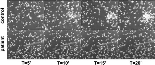 Figure 3. Lack of polarization and chemotaxis of purified neutrophils toward a micropipette from which an optimal dose of fMLP is diffusing in a prewarmed chamber containing healthy control cells (top panel) or patients' cells (bottom panel). Representative for 4 patients.