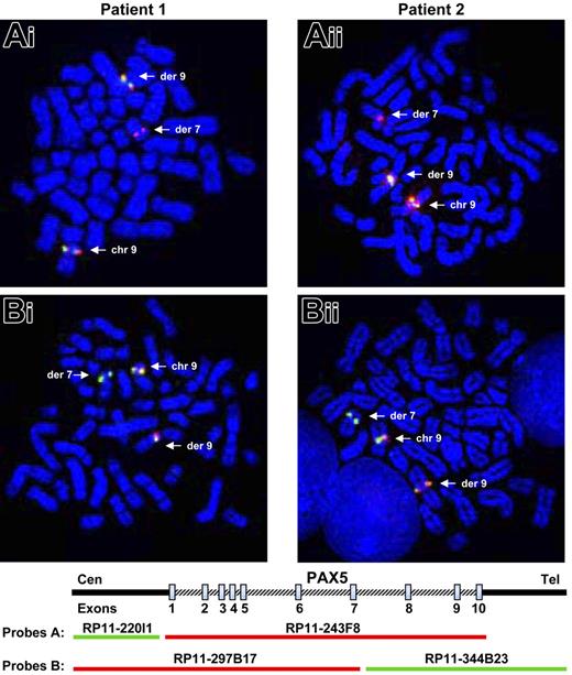 Figure 1. Rearrangement of the PAX5 gene detected by FISH. FISH with PAX5 probes on both patients. (Ai-ii) FISH with PAX5 probe A: the RP11-243F8 BAC probe corresponds to the entire sequence of PAX5 gene. The signal of this probe is split between derived chromosomes 7 and 9 (arrows). (Bi-ii) FISH with PAX5 probe B: the BAC RP11-297B17 and RP11-344B23 correspond respectively to the 5′ part of the PAX5 gene up to intron 7 and the 3′ part of PAX5 from intron 7. FISH only shows a split of the RP11-344B23 probe. Thus, PAX5 is rearranged in both patients between exons 7 and 10.