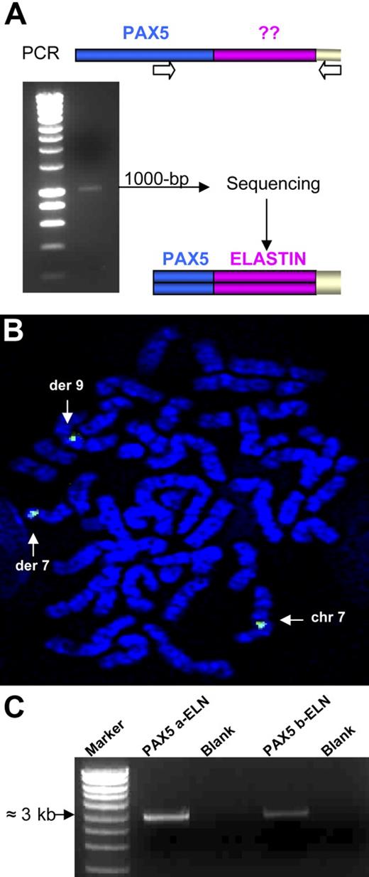 Figure 2. Rearrangement of the ELN gene. (A) 3′ RACE PCR was performed using a PAX5-specific primer and an anchor primer. We obtained a 1000-bp product that corresponds after sequencing to a part of PAX5 fused to the ELN transcript from its exon 2. (B) FISH analysis with the ELN BAC probe (CTD-2278A11). (C) Amplification of the 2 alternative transcripts by RT-PCR: PAX5a-ELN and PAX5b-ELN from the mRNA of patient 1.