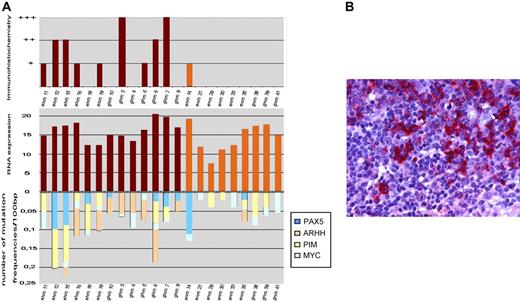 Figure 1. Expression of AID in MALT lymphoma and extranodal DLBCL. (A) The comparison of activation-induced cytidine deaminase (AID) mRNA expression, immunohistochemistry, and frequency of mutations is shown. Compared with centroblast mRNA AID/β-actin was expressed in all mutated evaluable MALT lymphomas and DLCBL, likewise. (B) The positive staining for AID protein in neoplastic B cells of extranodal DLBCL is shown. Images were captured with a Leica DMLB microscope (Leica, Bensheim, Germany) using a Leica PL FLUOTAR objective lens (40×/0.70) and a Leica DC200 camera. Images were imported directly into PowerPoint (Microsoft, Redmond, WA) using the Leica DC200 camera software (version 2.51).