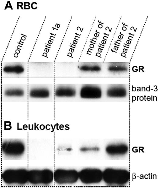 Figure 3. Western blot analysis of blood cell extracts. Immunoblot analysis of (A) erythrocyte and (B) total leukocyte lysates of healthy controls as well as of patient 1a, patient 2, and patient 2's parents. All samples were loaded on the same gel, allowing direct comparison. They are shown separately for clarification. Band-3 and β-actin served as loading controls. Note the faint GR staining in patient 2's leukocyte lysate.