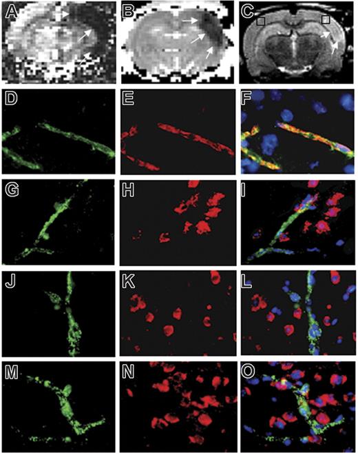 Figure 1. Immunohistochemical staining of LRP in the ischemic brain 3 hours after middle cerebral artery occlusion. Animals were subjected to MCAO followed by continuous MRI monitoring of cerebral blood flow (CBF), apparent diffusion coefficient (ADC) of water, and tissue changes associated with cerebral edema (T2-weighted images), followed by immunohistochemical analysis of LRP expression 180 minutes after the onset of the ischemic insult. (A-B) Changes in CBF (A) and ADC of water (B) 30 minutes after MCAO. Arrows in panel A depict the area of the brain with a greater than 80% decrease in CBF (dark zone). Arrows in panel B denote the area of irreversibly injured brain (dark area). (C) T2-weighted image of the same brain of panels A and B. Arrows depict the edge of the ischemic tissue with evolving cerebral edema (hyperintense signal). The black squares represent the areas of the brain were the immunohistochemical staining for LRP expression was performed. (D-I) Immunohistochemical staining with an antibody against CD31 (PECAM-1) (D,G) and the R2629 LRP antibody (E,H) in the area corresponding to the black squares in the ischemic (D-F) and nonischemic (G-I) hemispheres. Panels F and I correspond to merged images. (J-O) Immunohistochemical staining with an antibody against von Willebrand factor (J,M) and the 11H4 LRP antibody (K,N) in the area corresponding to the black squares depicted in panel C in the ischemic (J-L) and nonischemic (M-O) hemispheres. Panels L and O correspond to merged images. Images were visualized using a Leica DMRBE microscope (Leica, Houston, TX) equipped with a 100×/1.30 numerical aperture (NA) oil objective lens and a Leica DC 500 camera. Images were processed using software provided by the camera manufacturer.
