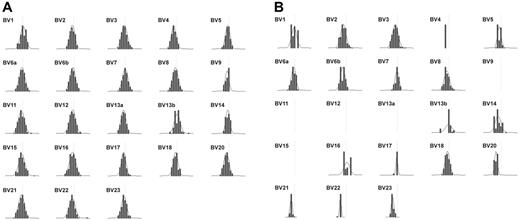 Figure 2. Spectratype analysis of patient TCR Vβ repertoire. Expression of the indicated Vβ families in (A) healthy volunteer and (B) patient cells was assessed by PCR amplification and run-off reaction. Depicted are density peak histograms for each Vβ family with CDR3 sizes centered around a CDR3 length = 30 bp (vertical line) shown on the x-axis, and peak fluorescence intensity on the y-axis. The calculated Kullback-Leibler divergence (DKL), a statistical measure of divergence from maximum diversity, was 0.05 for healthy volunteer histograms and 0.25 for patient histograms. The higher patient DKL indicates a less diverse (more oligoclonal) distribution of peaks.