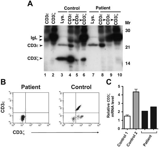 Figure 4. Analysis of CD3ζ protein and mRNA expression in patient T cells. (A) Patient and healthy volunteer sorted CD3ε+ PBMCs were lysed in digitonin lysis buffer and either sequentially immunoprecipitated with 2 rounds of anti-CD3ε Ab followed by anti-CD3ζ Ab, or subjected to direct immunoblotting (lanes 3 and 7). Lysates were immunoblotted with anti-CD3ζ and anti-CD3ε Abs. Lanes 1 and 2 contain anti-CD3ε– or anti-CD3ζ–coated beads incubated with lysis buffer alone, as indicated. (B) Patient and healthy volunteer PBMCs were first stained with PerCP-labeled anti-CD3ε to assess cell surface CD3ε expression. The cells were then fixed and permeabilized, stained with FITC-labeled anti-CD3ζ Ab, and analyzed by flow cytometry. Shown are 2-color plots of surface CD3ε and intracellular CD3ζ expression. (C) Patient CD3ε+ cells were obtained from 2 different sorted PBMC samples (from different dates). Healthy volunteer sorted CD3ε+ PBMCs were isolated from 2 unrelated individuals (control 1, control 2). cDNA was prepared from sorted cells and CD3ζ transcripts were quantified by SYBR green real-time PCR. Levels of CD3ζ mRNA were normalized to those of β-actin for each sample. Values represent mean ± SEM of duplicate determinations.