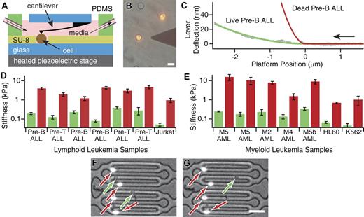 Figure 1. Chemotherapy-induced cell death increases the stiffness of leukemia cell populations measured by AFM and microfluidic channels. (A) An illustration of the AFM setup (not to scale). A single cell sitting within a microwell is immobilized for force microscopy with an AFM cantilever. A polydimethylsiloxane (PDMS) collar is pressed on the glass to create an open-air chamber. Tubes entering and exiting the chamber continually pass media through, keeping the media fresh over the long time scale of the experiments. The piezoelectric stage moves vertically, causing the cantilever to deflect against the cell. The stage is maintained at 37°C throughout the experiment. (B) An epifluorescence/brightfield overlay of a typical experiment. Seen here are an AFM cantilever tip and 2 dead K562 cells (PI positive, fluorescent), with the left cell immobilized in a microwell. An empty microwell is at the top. Scale bar is 20 μm. (C) Two typical cell indentation acquisitions. As the piezoelectric platform moves the cells up against the cantilever (in the direction of the arrow), the cantilever deflects. When the curves are fit to an elastic Hertzian model, the stiffness of the cells can be determined. The stiffness of a pre-B-ALL cell exposed to 1 μM dexamethasone (red) was 4.3 kPa whereas the stiffness of a control (not exposed to chemotherapy) pre-B-ALL cell (green) from the same patient was 0.2 kPa. (D) Dead (red) lymphoid leukemic cells exposed to 1 μM dexamethasone are significantly stiffer than untreated (green) cells. (E) Dead (red) myeloid leukemic cells exposed to 1 μM daunorubicin are significantly stiffer than untreated (green) cells. Error bars represent standard error. (n > 15, P < .05 for all comparisons of dead/untreated populations). (F) Dual brightfield/epifluorescence microscopy of dexamethasone-exposed pre-B-ALL cells that were passed, from left to right, through PDMS microfluidic channels modeling a branching microvasculature network. Dead (PI+) cells (red arrows) were more likely than live (unstained) cells (green arrows) to initiate obstruction and cause cell aggregation in the 5-μm wide by 12-μm tall, capillary-sized channels. Frame from panel G was taken 15 seconds after that seen in panel F, illustrating the relative mobility of 2 live cells, one of which has left the field of view, compared with dead cells that remain fixed in place. Scale bar is 10 μm.