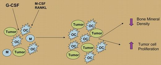 G-CSF (filgrastim) stimulation in the bone promotes, in concert with M-CSF and RANKL, the expansion and differentiation of macrophages (Ms) to osteoclasts (OCs), increasing osteoclast activity and leading to decreased bone mineral density and increased tumor cell production.