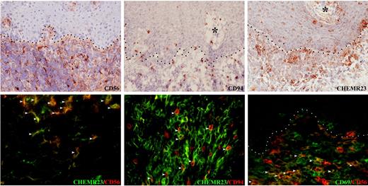 Figure 5. CD56+ and CD94+ NK cells coexpress ChemR23 in OLP. In OLP, CD56+, CD94+ NK cells (top series) and ChemR23+ cells (middle left) occur in the inflammatory infiltrate and within the epithelium. About 70% of CD56+ and CD94+ NK cells coexpress ChemR23 (middle right and bottom left; white arrowheads). A minor subset (about 40%) of CD56+ NK cells that infiltrate OLP lesions express the activation marker CD69 (bottom right, white arrowheads) Dot lines and asterisks indicate, respectively, stromal-epithelial interfaces and stromal papillae. Original magnification × 200 (for streptavidin-peroxidase staining) and × 400 (for immunofluorescence).
