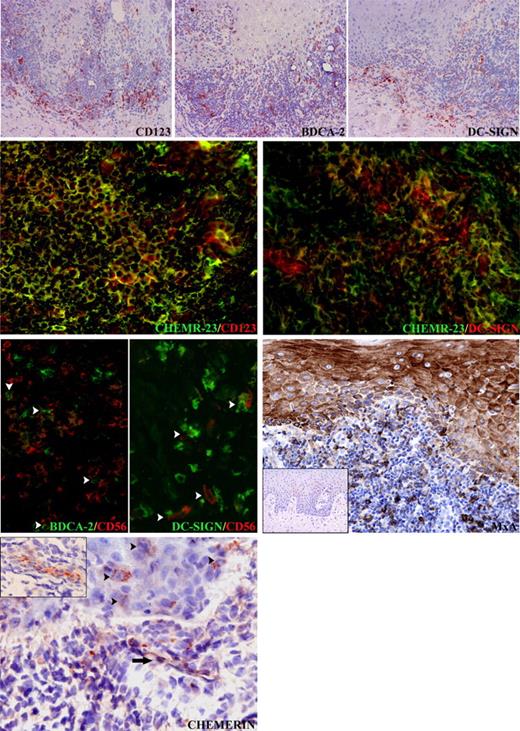 Figure 6. Chemerin as a colocalization signal for CD123+/BDCA-2+ plasmacytoid DCs, DC-SIGN+ myeloid DCs, and NK cells in OLP. In OLP, CD123+/BDCA-2+ plasmacytoid DCs and DC-SIGN+ DCs are present in the inflammatory infiltrate and within the epithelium. The vast majority of CD123+ plasmacytoid DCs and a proportion of DC-SIGN+ DCs coexpress ChemR23+ cells. Close cell-to-cell contacts (white arrowheads) can be observed between BDCA-2+ plasmacytoid DCs and CD56+ NK cells as well as DC-SIGN+ DCs and CD56+ NK cells. Epithelial and inflammatory cells in oral lichen planus express MxA, as opposed to oral mucosal biopsies from patients showing reactive acanthosis (inset), which is completely negative. In the same sections, chemerin is expressed on the luminal side of the endothelial cells (black arrows and inset). In addition scattered chemerin-positive cells with epithelial morphology are detectable in the epithelium (black arrowheads). Original magnifications are all × 400, except top row (× 100) and MxA (× 200) and insets: MxA (× 50) and chemerin (× 300).